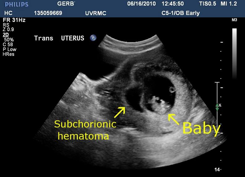 Subchorionic Hemorrhage: Causes, Complications In Pregnancy